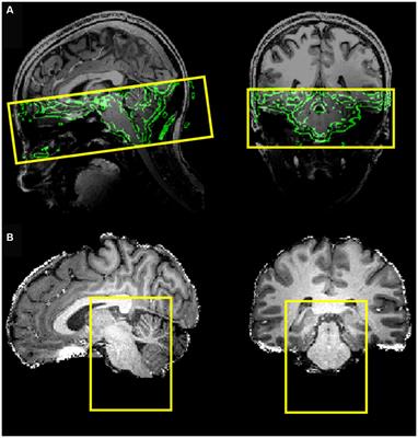 Functional MRI activation of the nucleus tractus solitarius after taste stimuli at ultra-high field: a proof-of-concept single-subject study